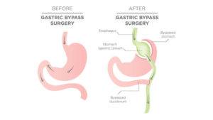 Laparoscopic Gastric Bypass - KC Bariatric